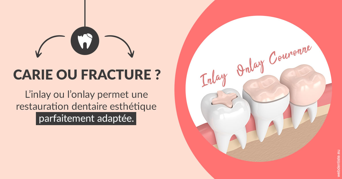 https://dr-clot-didier.chirurgiens-dentistes.fr/T2 2023 - Carie ou fracture 2