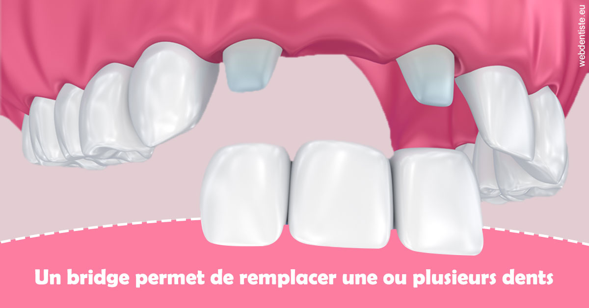 https://dr-clot-didier.chirurgiens-dentistes.fr/Bridge remplacer dents 2
