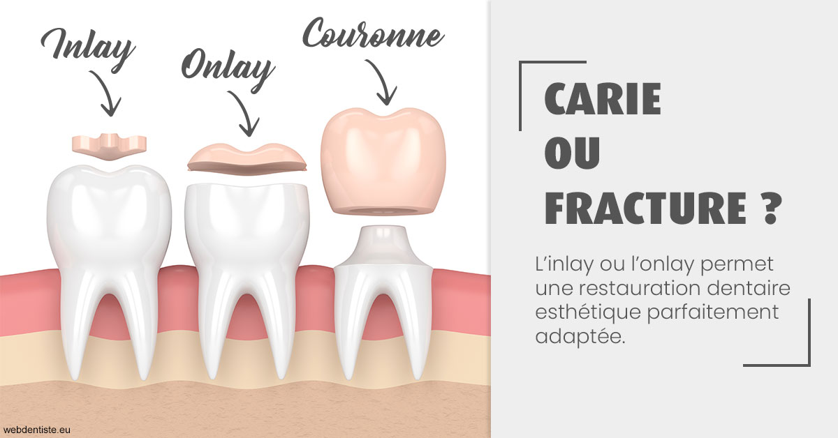 https://dr-clot-didier.chirurgiens-dentistes.fr/T2 2023 - Carie ou fracture 1