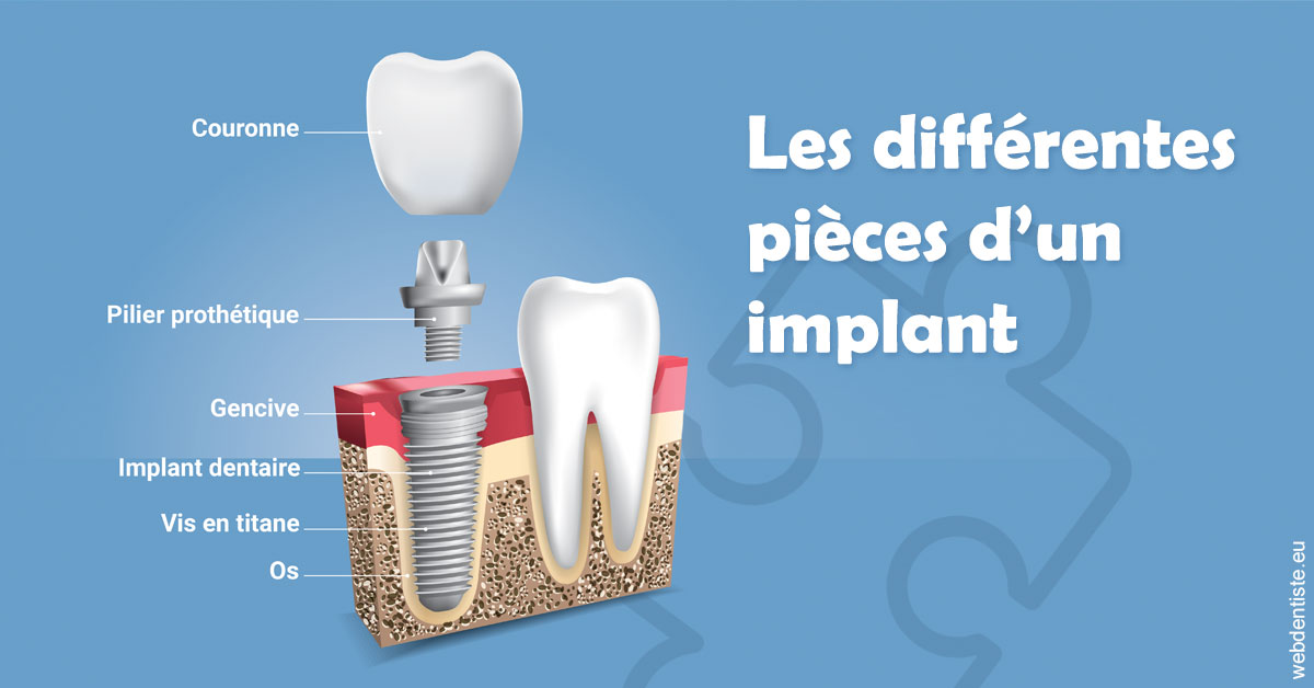 https://dr-clot-didier.chirurgiens-dentistes.fr/Les différentes pièces d’un implant 1